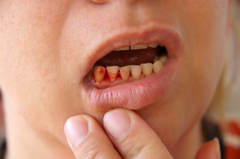 Chảy máu chân răng là bệnh gì ( Nguồn Internet) 