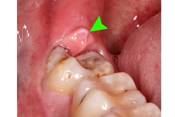 Viêm nhiễm do răng khôn 