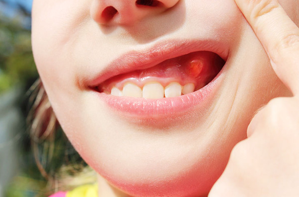 Chảy máu chân răng dẫn đến nhiễm trùng nướu ( Nguồn Internet)