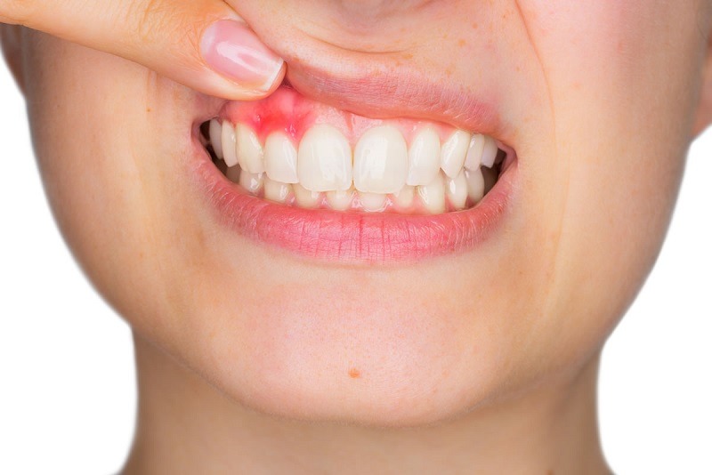 Nướu răng sưng to và đỏ (Nguồn Internet) 