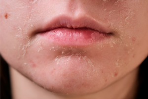 Biểu hiện của da khô sần và ngứa vào mùa đông